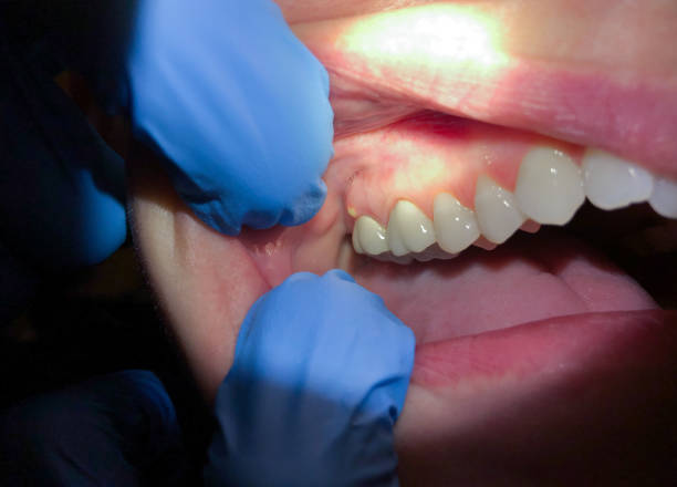 Best Emergency Dental Extractions in Stlman Valley, IL